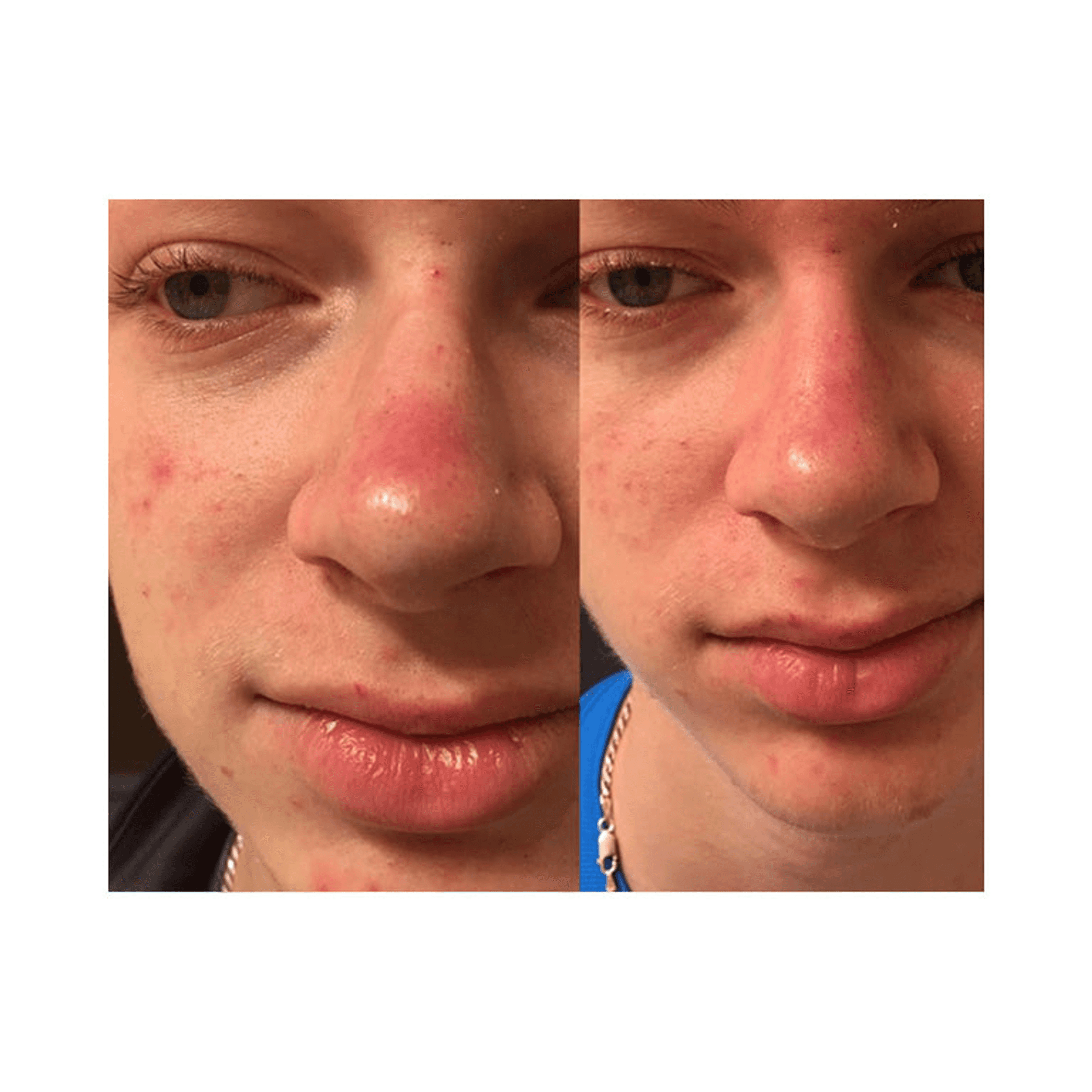 Acne treatment before-and-after close-up of nose, lips, and cheek blemishes