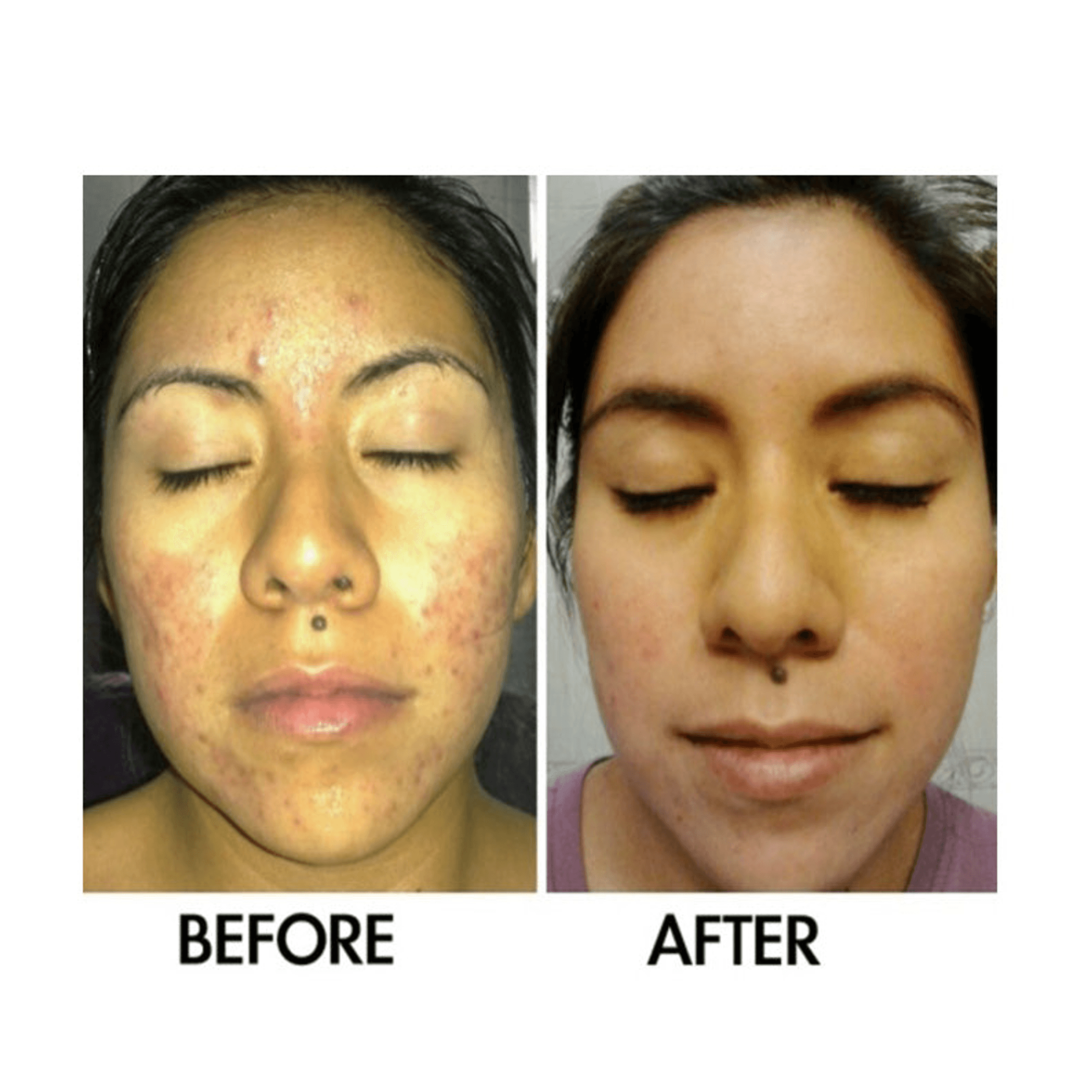 Acne treatment before-and-after top-down face comparison with improved clear skin