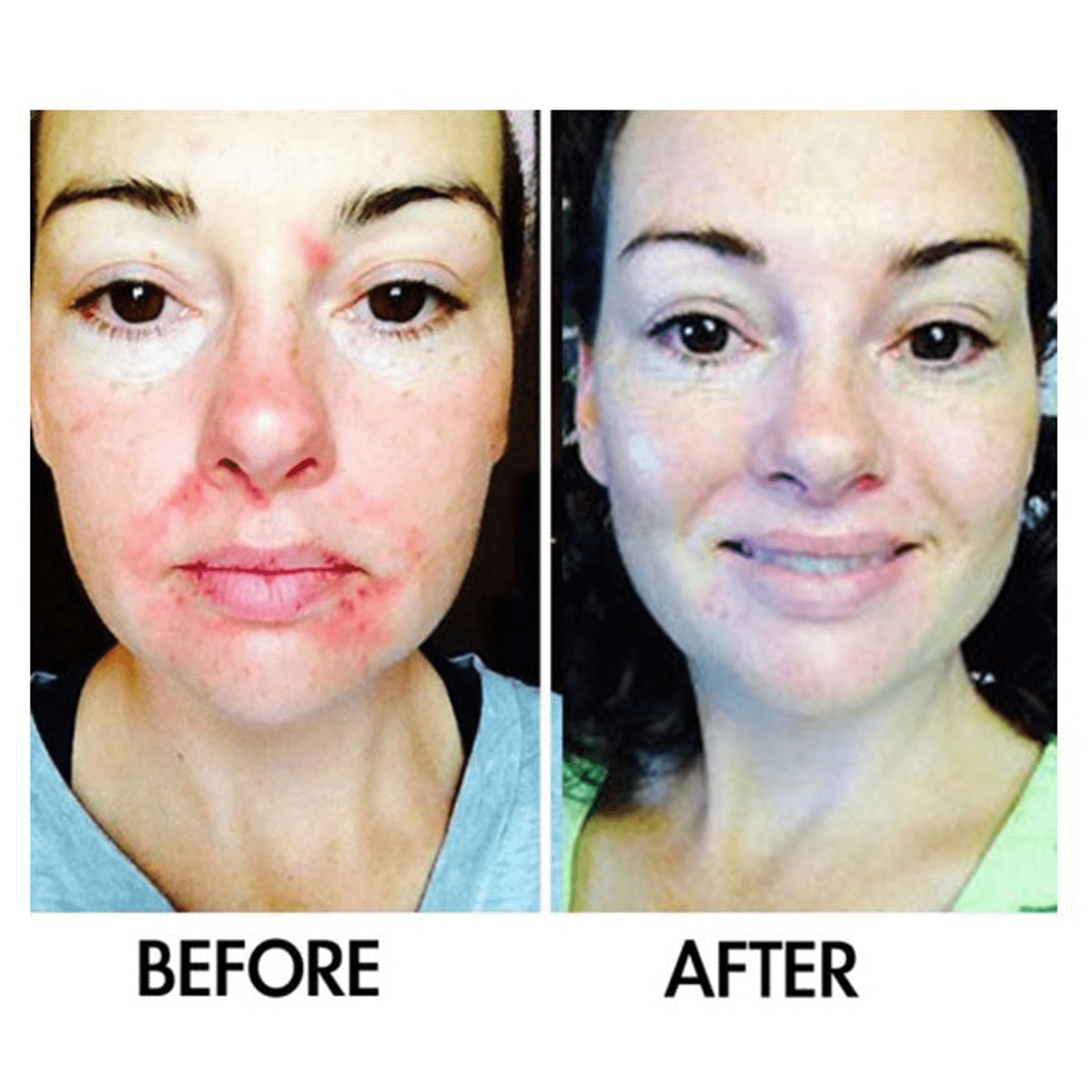 Acne treatment before-and-after front face with reduced facial redness and spots