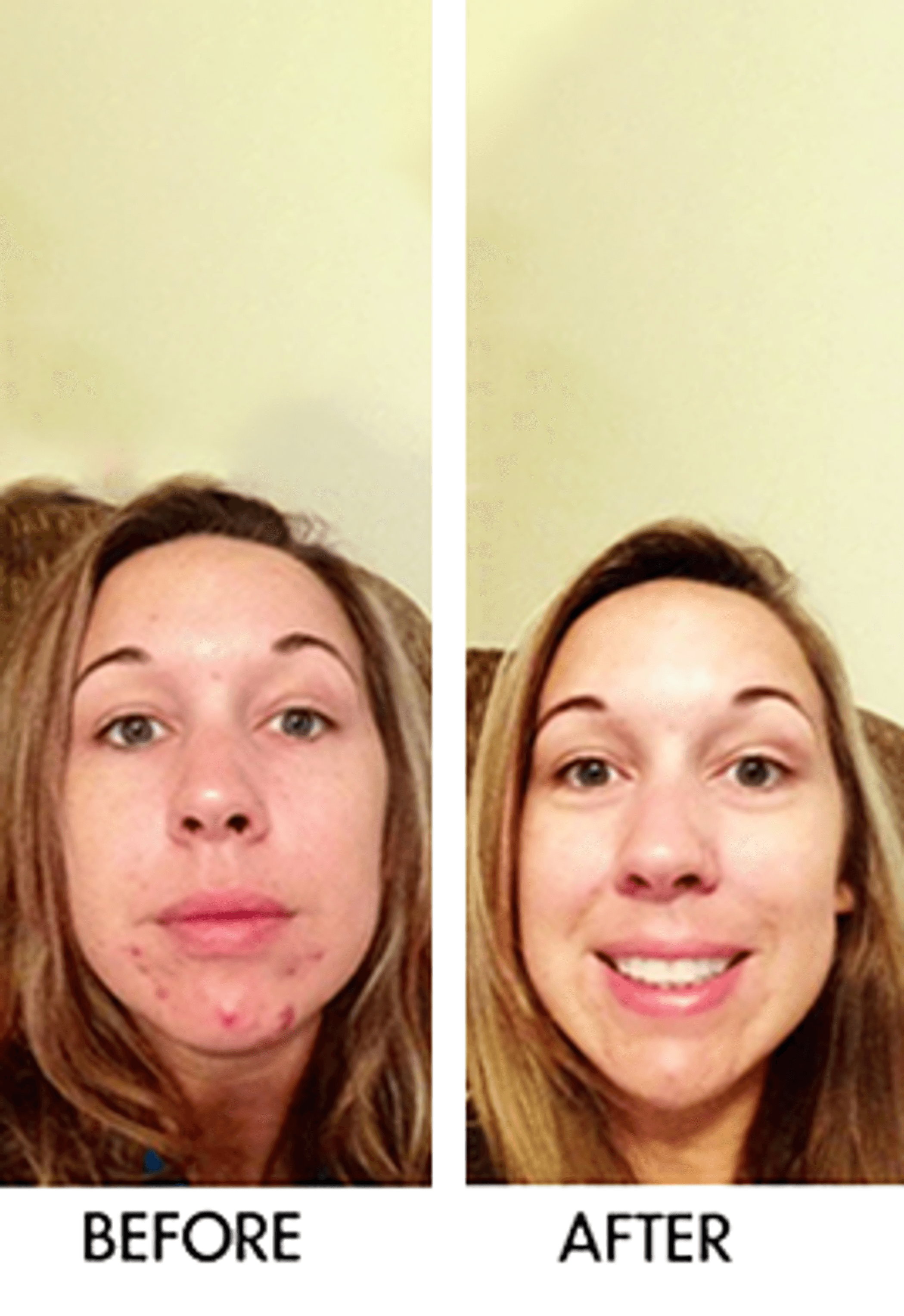 Acne treatment before-and-after face comparison with red blemishes on cheeks