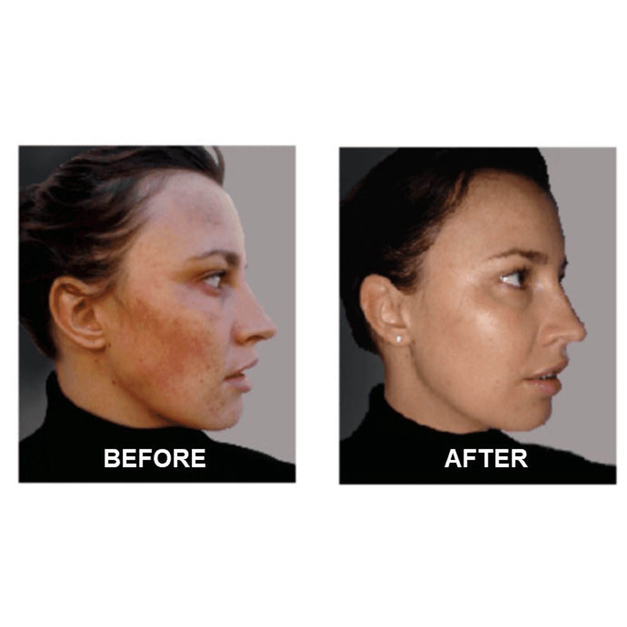 Acne treatment before-and-after side profile showing less redness and bumps