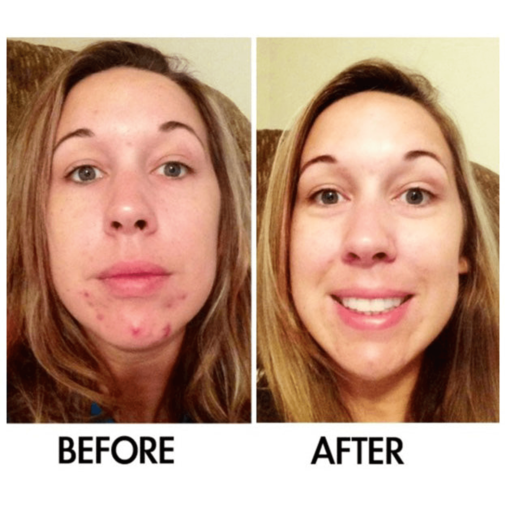 Acne treatment before-and-after front face showing smoother skin and fewer spots