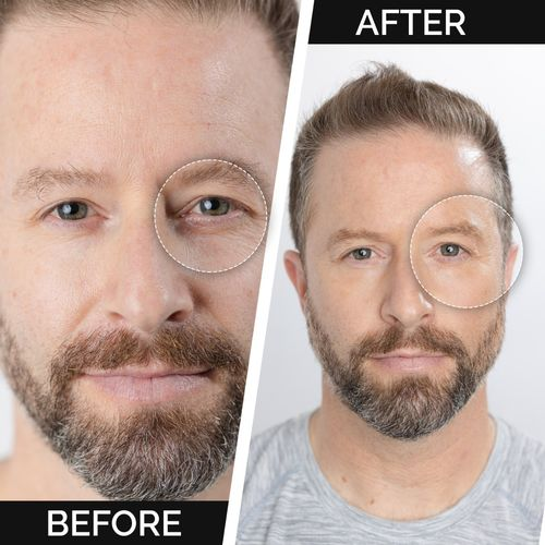 Men's face with eye-area concealer blend circle, before/after split