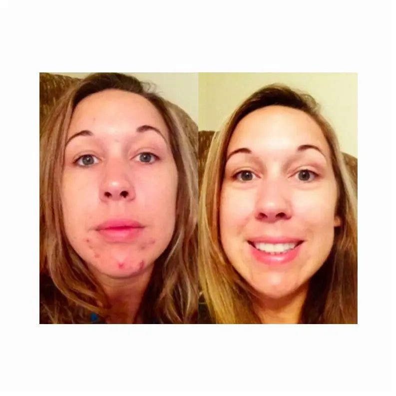 Clear Skin Results Regimen (3 Piece Set) Derm One