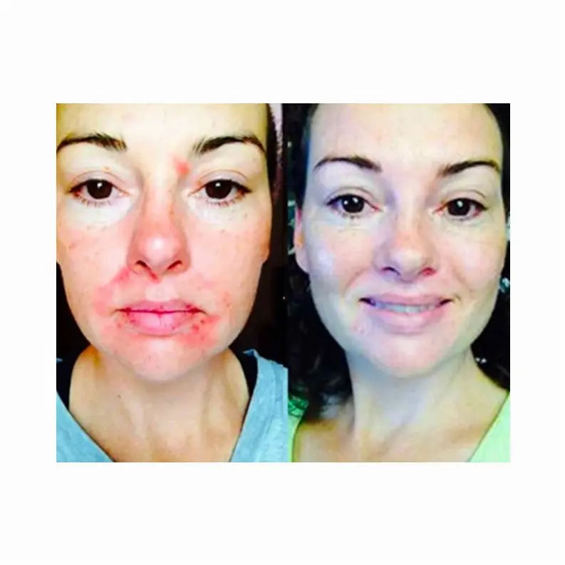 Clear Skin Results Regimen (3 Piece Set) Derm One