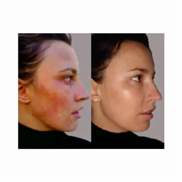 Two-Step All-Natural Acne Regimen with Bonus Zit Zapper (3 piece set) Derm One